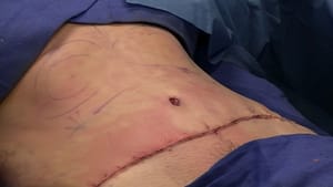 liposuction surgery